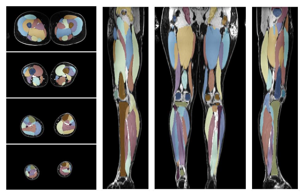 Overlay of automated muscle segmentation labels on dixon water image.